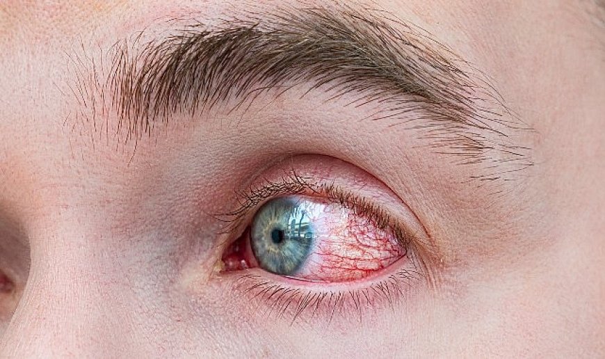 Bahar Alerjisinde Göz Ovalamak Körlüğe Yol Açıyor